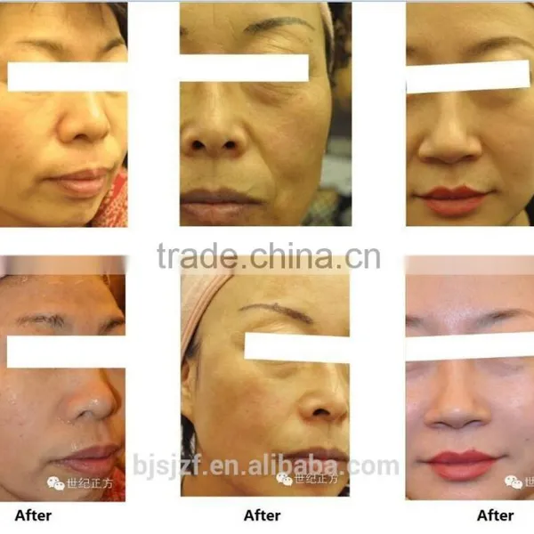 HIFU-C Hifu Treatment Device Wrinkle Removal Face Lifting photo-5