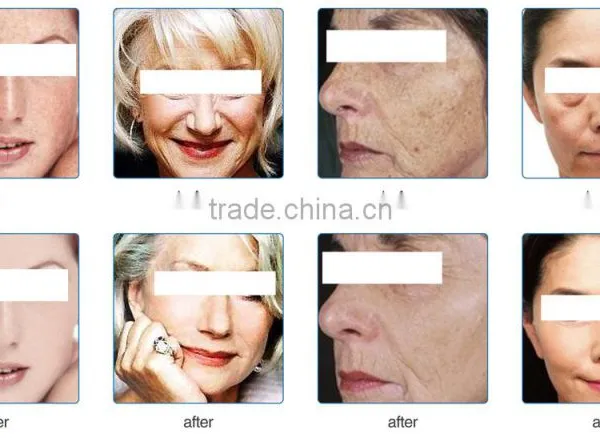 Pdt Led Photodynamic Therapy Pdt Collagen Led Light Therapy photo-5