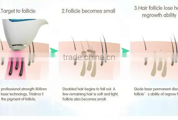 The Best Permanent Laser Hair Removal Machine for Hair Removal photo-5