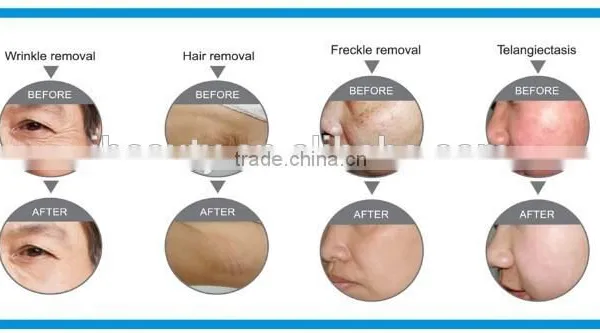 Portable IPL SHR&E-light Hair Removal Equipment&machine photo-4