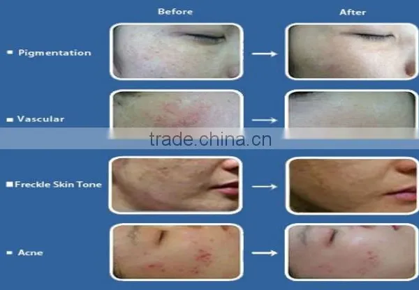 Medical Use CO2 Fractional Laser Scar Removal/fractional Co2 Laser in Dermatology photo-5