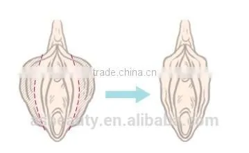 CO2 Fractional Laser Vaginal Tightening/laser Stretch Mark Removal Vaginal Rejuvenation Equipment Face Whitening photo-6