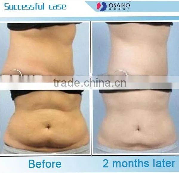 Body Reshape 2015 Cryo Lipo Shaping Zeltiq Criolipolisis Equipment Cryolipolysis Machine Handpieces photo-4