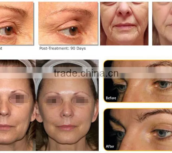 HIFU Wrinkle Removal & Hifu for Skin Tightening, Hifu Body Shape and Weight Loss photo-5