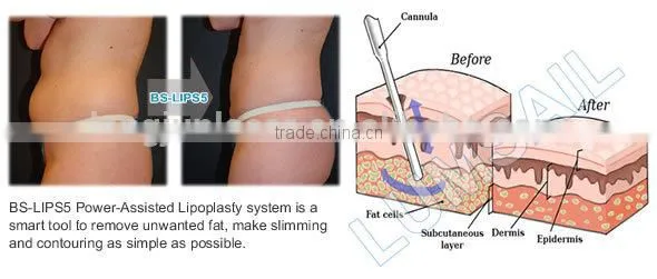 Liposuction and Self Fat-transplant Machine Medical Device BS-LIPS5 photo-4