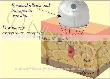 2015 Leading Technology HIFU Body Slimming,high Intensity Ultrasound Focused HIFU,HIFU photo-2