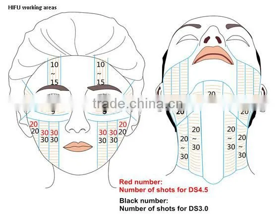 Hi Frequency Facial Machine GuangZhou BL High Intensity Focused Ultrasound HIFU Face Lifting Waist Shaping And Fat Removal Machine With CE High Focused Ultrasonic photo-5