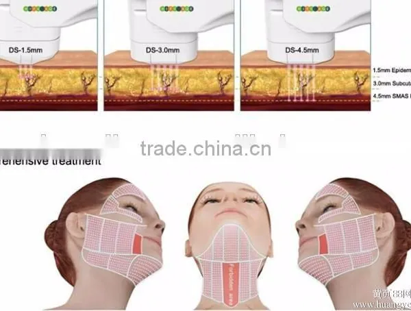 Hot Sale High Intensity Focuse Ultrasound Face Face and Neck Lift Machine photo-2