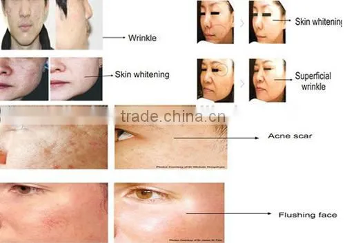 Micro Needle Fractional rf Machine / Fractional rf Face Lifting Device / Rf Fractional Micro Needle photo-6