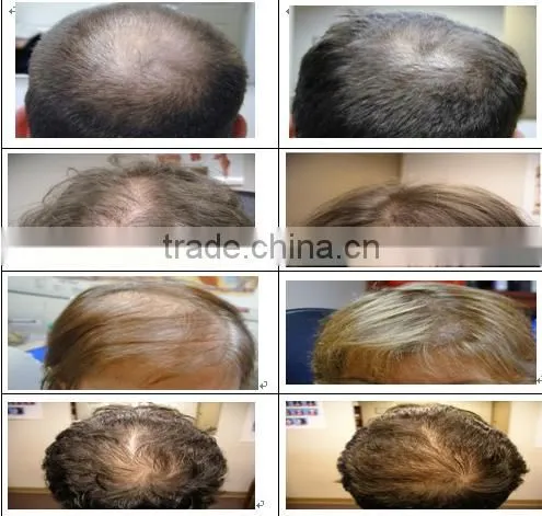 Good Effective Laser Hair Regrowth Machine/faster Laser Hair Regrowth Machine photo-6