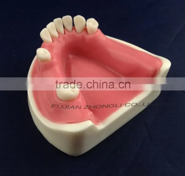 Medical Science Dental Implant Model With Soft Gingiva photo-3