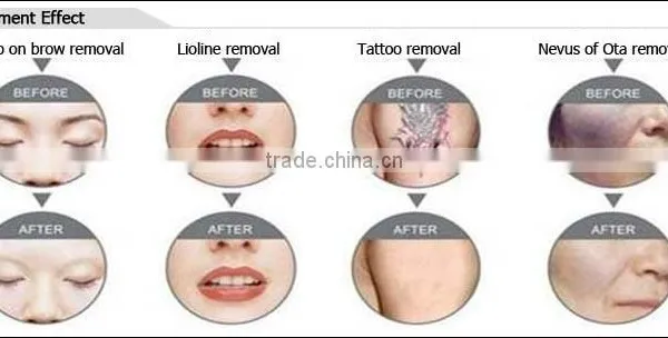 2016 Big Sale 1500mj Portable 532 nm & 1064 nm nd Yag Laser Tattoo With CE photo-5