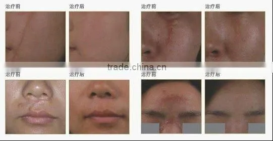 Wart Removal Salon Vertical RF Co2 Wrinkle Removal Fractional Laser Skin Treatment Machine Sun Damage Recovery Sun Damage Recovery photo-5