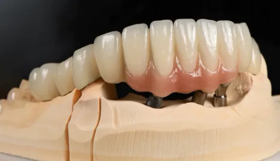 Dental Laboratory Full Ceramic Zirconia Crown Manufacturer in China photo-4