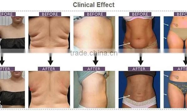 High Quality Homeuse 650nm 4D Lipo Laser With Microcurrent Slimming Machine for Fat Loss and Body Shaping photo-6
