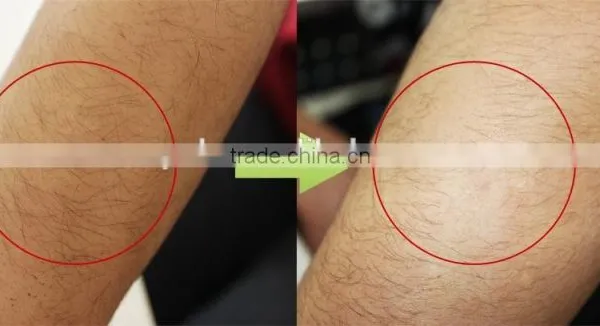 Permanent Hair Removal Diode Laser 810nm Diode Lazer/diode Laser 808 photo-3