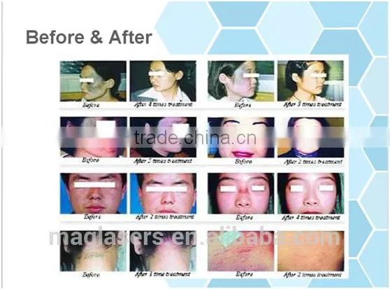 Wart Removal Low Price Multifunctional Co2 Laser Fractional Machine/laser Clinic And Medical Uses Vaginal Rejuvenation photo-6