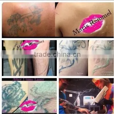 Tattoo Pigment Removal Beauty Machine photo-5