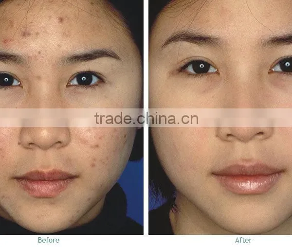 40W Fractional CO2 Laser Acne Scar & Wrinkle Removal / Co2 Laser Surgical Product Vaginal Applicator photo-3