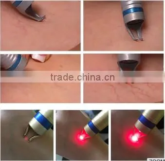 Bipolar rf Skin Tightening Machine /wrinkle Removal and Face Lifting Machine/home Use Factional rf Equipment photo-4