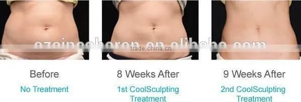 Cellulite Freezing Cool Shaping Body Massage Equipment for Weight Loss photo-4