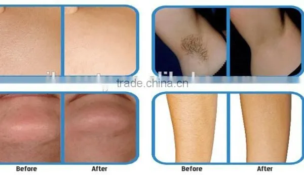 Portable IPL SHR&E-light Hair Removal Equipment&machine photo-5