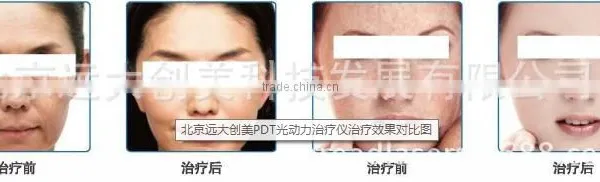 Red Led Light Therapy Skin 2016 New! Cheap Professional PDT Led Beauty Machine For Acne Removal Skin Care Skin Whitening photo-6
