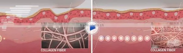 Skin Tighten HIFU Machine!!! Vaginal Tightening HIFU /HIFU Hips Shaping Wrinkles Removal Machine For Sale Back Tightening photo-4