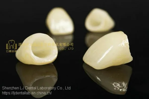 Dental Crown E.Max Ceramic, Porcelain Crown, Dental Veneers, Laboratoire Dentaire, Dentallabor, Laboratorio Dental, Dental Laboratory, Shenzhen LJ Dental Lab China photo-2