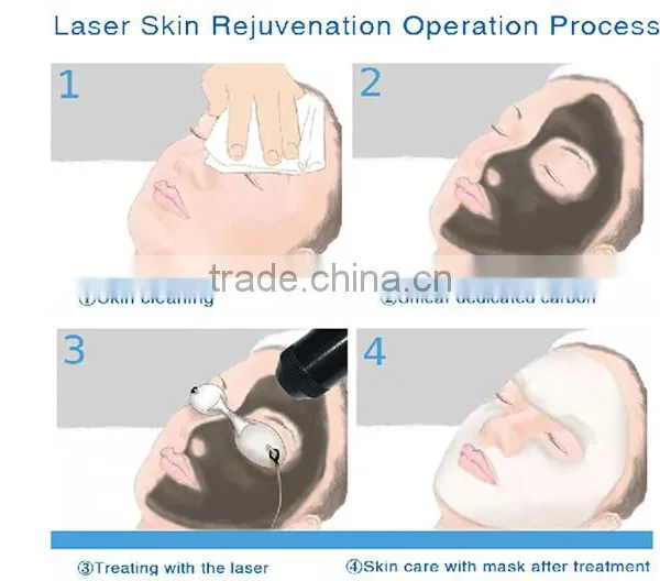 Summer Women Men Use Q-switched Laser ND YAG Tattoo Removal photo-6