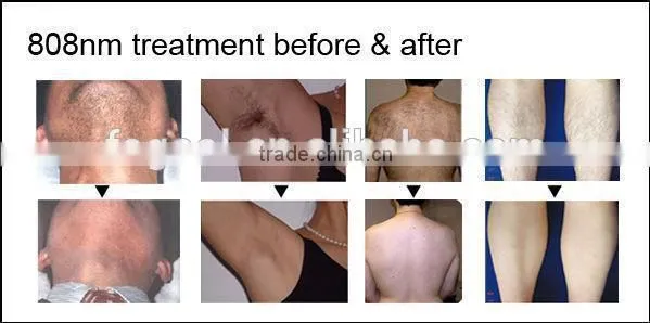 Home Use Body Hair Removal Body&Facial Laser Device photo-5