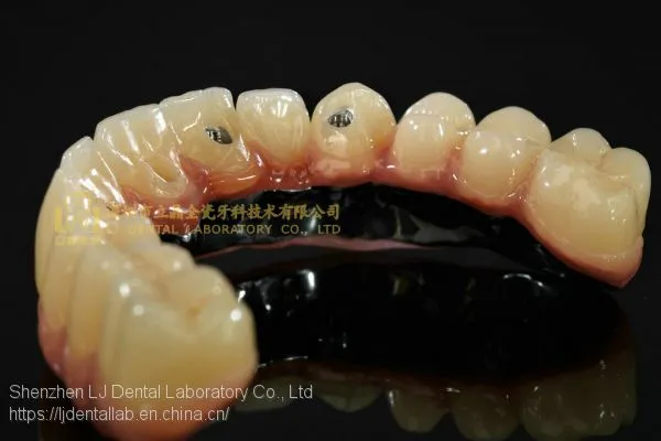 Full-arch Implant Bridge Prosthesis, Implant Denture Framework, Implant Prosthesis, Laboratoire Dentaire, Dentallabor, Laboratorio Dental, Dental Laboratory, Shenzhen LJ Dental Lab China photo-4