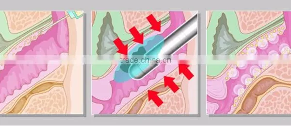 YUWEI Most Professional Hifu Technology Hifu 2000 Shots Vaginal Tightening Beauty Machine With Good Price Deep Wrinkle Removal photo-5
