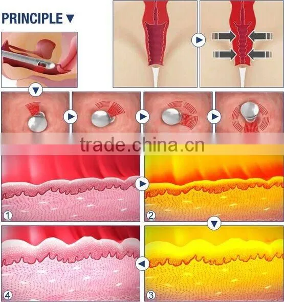 1.0-10mm 2016 Hot Selling Ultrasonic Hifu Vaginal Tightening Machine Skin Tightening photo-5
