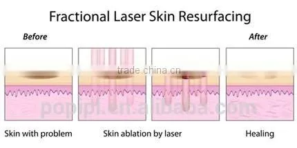 Wart Removal Vagina Cleaning Skin Resurfacing Fractional Co2 Birth Multifunctional 40w Mark Removal Face Whitening Laser Machine Face Lifting Warts Removal photo-2
