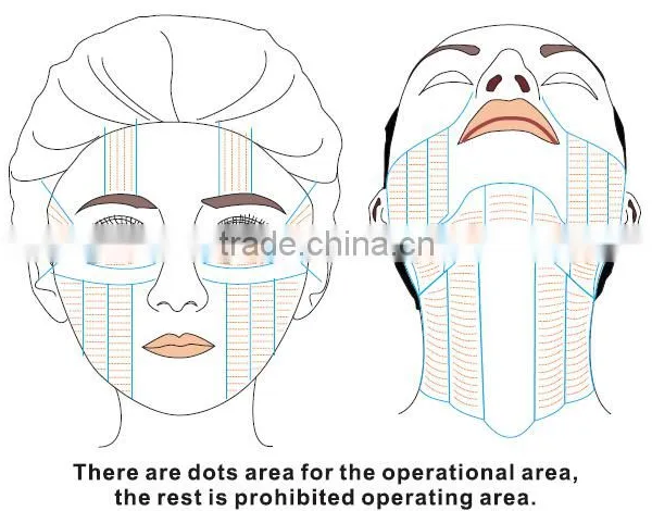 Improving Jaw Line High Intensity Focused Ultrasound Ultrasound Hifu Slimming/hifu Machine Portable photo-5