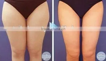 Reduce Cellulite Cryolipolysis Fat Freeze Skin Tightening Slimming Machine/cryolipolysis Slim Freeze Belt Machine photo-6