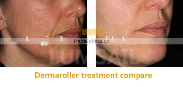 3 in 1 Derma Roller Dermaroller for Treatment of Acne Scars and Healing Wounds photo-5