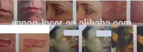 Eye Wrinkle / Bag Removal Fractional Co2 Laser 0.1mj-300mj Stretch Mark Removal Acne Scar Removal Machine Warts Removal photo-3