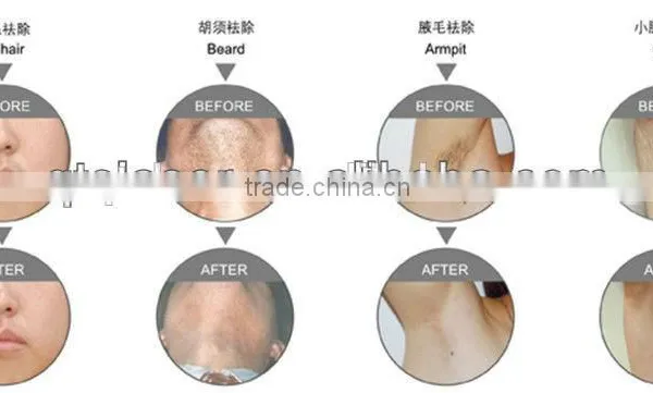 2015 Hongkong Beauty Expo 808nm Diode Laser Hair Removal Machine photo-5