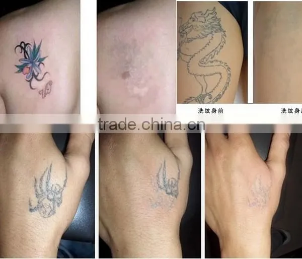 *Stationary 1064 nm 532nm Q-swithed Nd-yag Laser Alexandrite Laser Tattoo Removal Beauty Machine photo-6