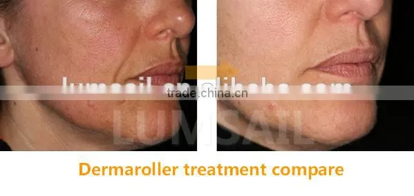 New 2016 Skin Care Derma Roller Dermaroller for Acne Removal Beauty Equipment photo-4