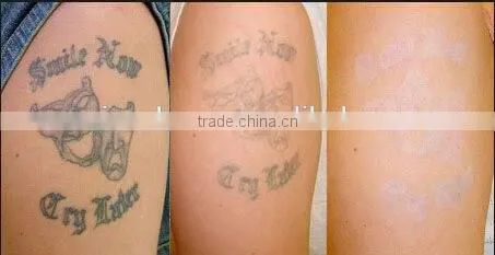 Tattoo Pigment Removal Beauty Machine photo-4