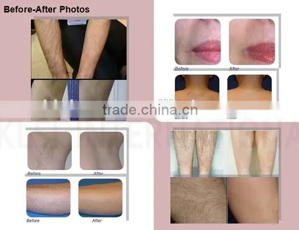 2016 New Arrival Most Advanced 808nm Diode Laser /diode Laser Hair Removal/ Diode Laser 808 photo-6