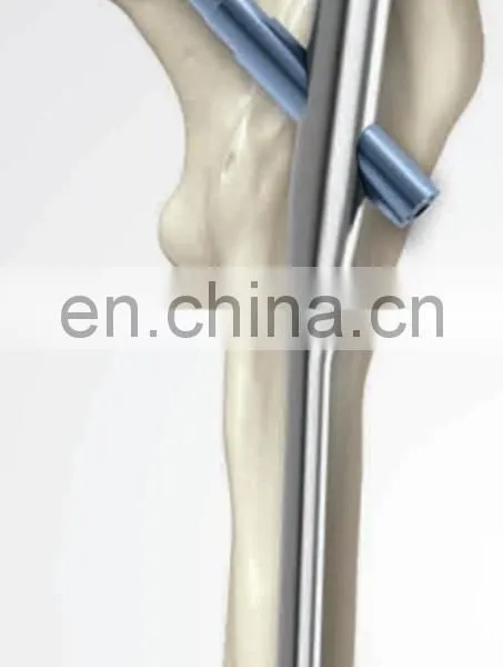 Orthopedic Trauma Implants PFNA photo-6
