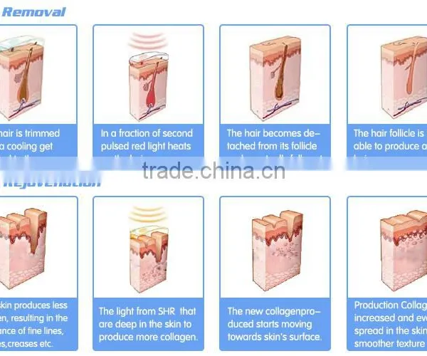 Manufacture Supply Permanent Hair Removal Elight Ipl/shr Hair Removal Machine photo-3