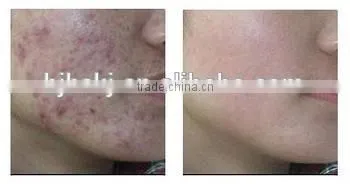 Portable Fractional Co2 Laser Surgical Products photo-4