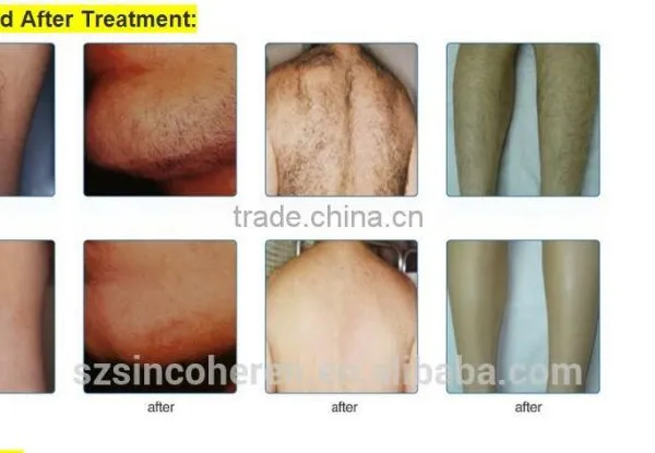 Sincoheren FDA CE Approved Hair Removal Machine,OPT FP Technology NYC-3 photo-4