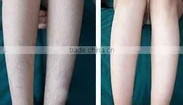 12x12mm IPL Diode Laser Hair Removal Bode Machine Price/IPL Skin Rejuvenation Machine Home photo-6