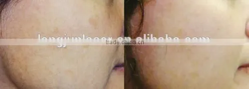1 HZ Q Switch Laser Tattoo Removal Machine For Skin Tattoo Treatment 1-10Hz photo-5